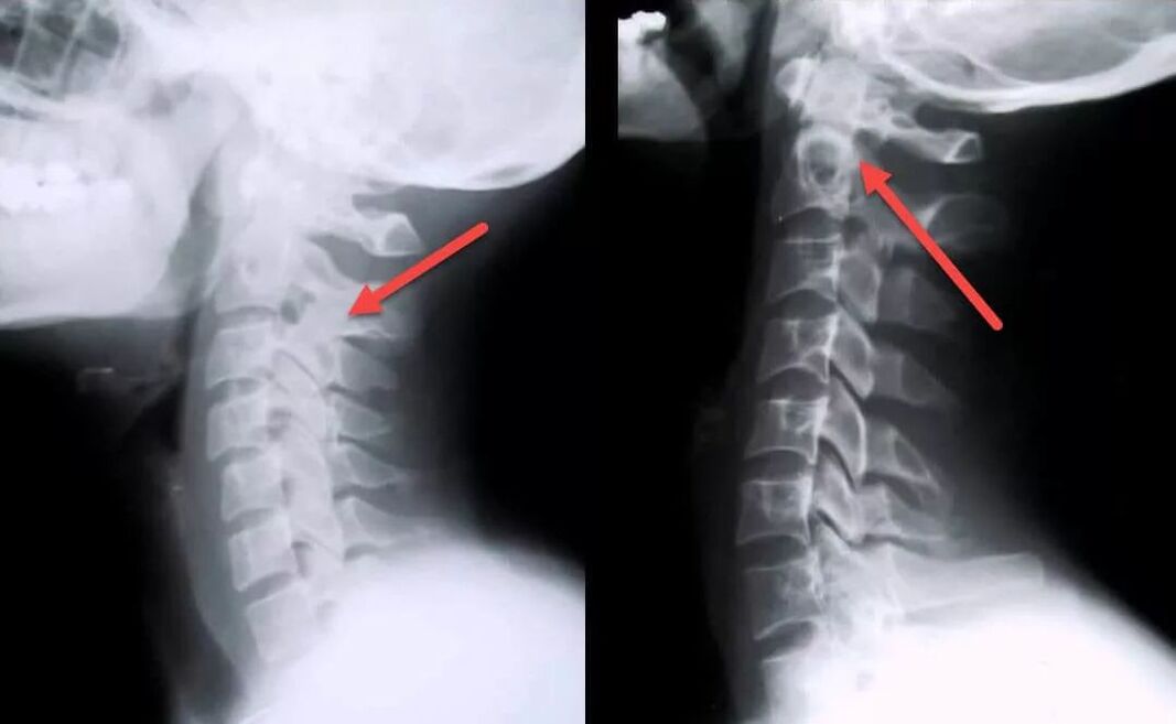 nyaki osteochondrosis diagnózisa