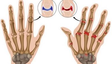 Az ízületi gyulladás és arthrosis fő különbségei