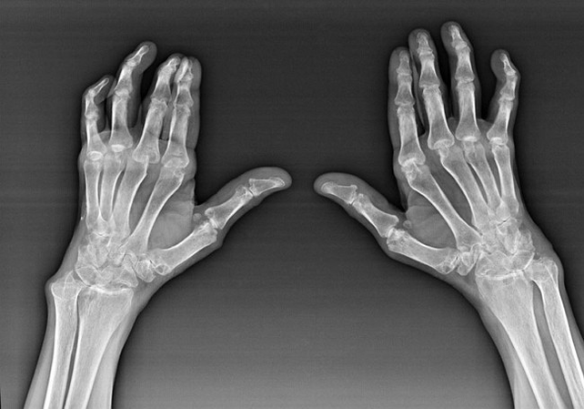 Az ujjak ízületeinek diagnosztikája