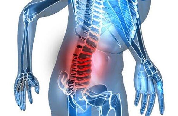 A gerinc deformitása az ágyéki osteochondrosis negyedik szakaszában