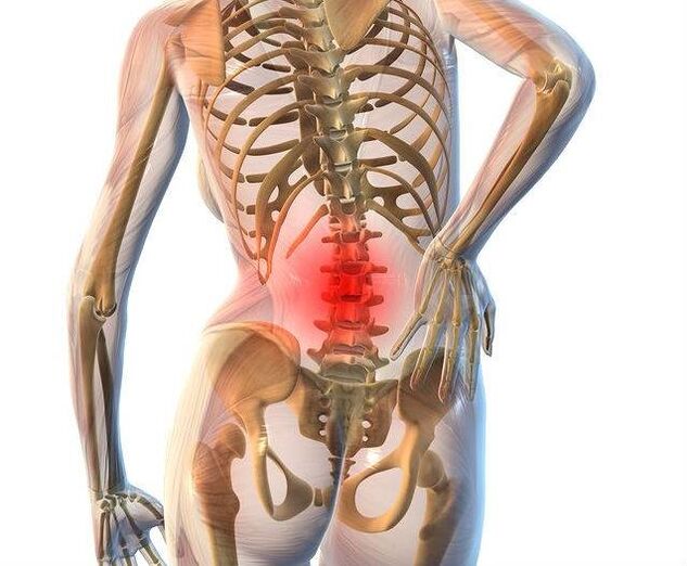 Az ágyéki gerinc osteochondrosisa