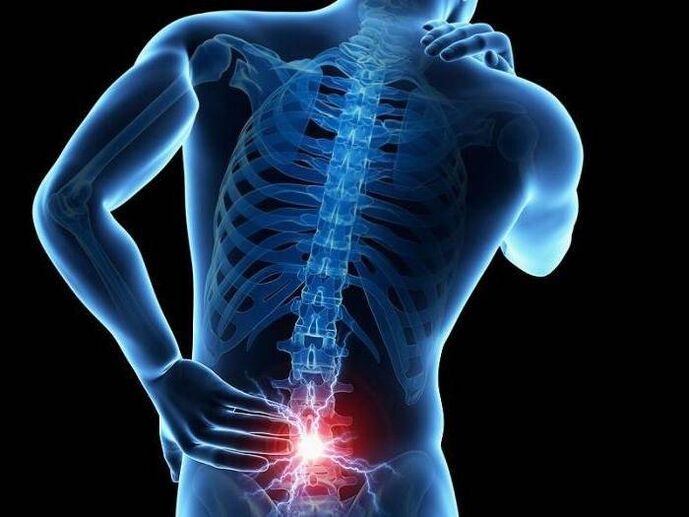 Radculitis esetén a becsípett ideggyökerek éles fájdalom megjelenését váltják ki a hát alsó részén