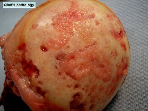 Arthrosis által érintett porcos felület