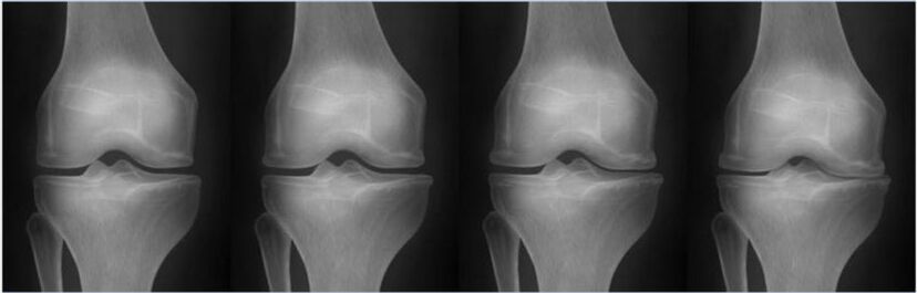 Az arthrosis szakaszai a Kellgren-Lawrence osztályozás szerint