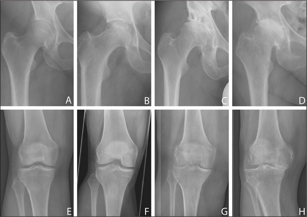 Az ízületi arthrosis kialakulásának szakaszai röntgenfelvételen