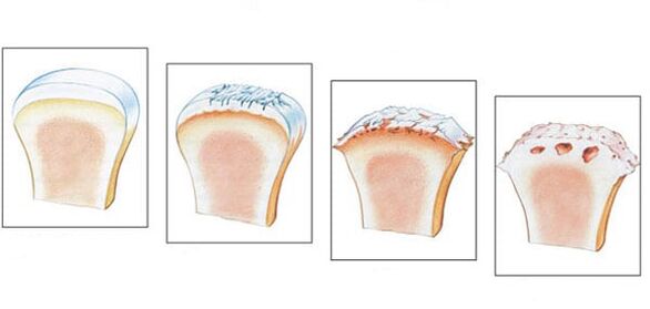 Egészséges ízület és 3 fokos arthrosis fejlettség